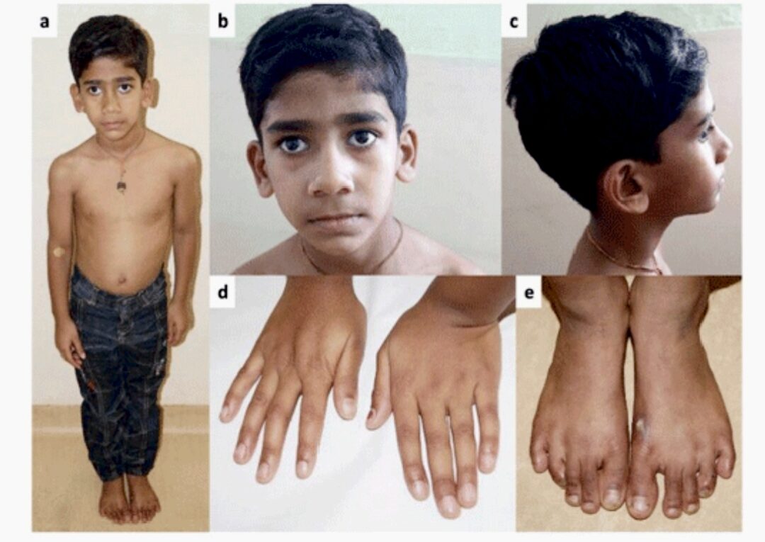 Understanding Marfan Syndrome: A Comprehensive Overview