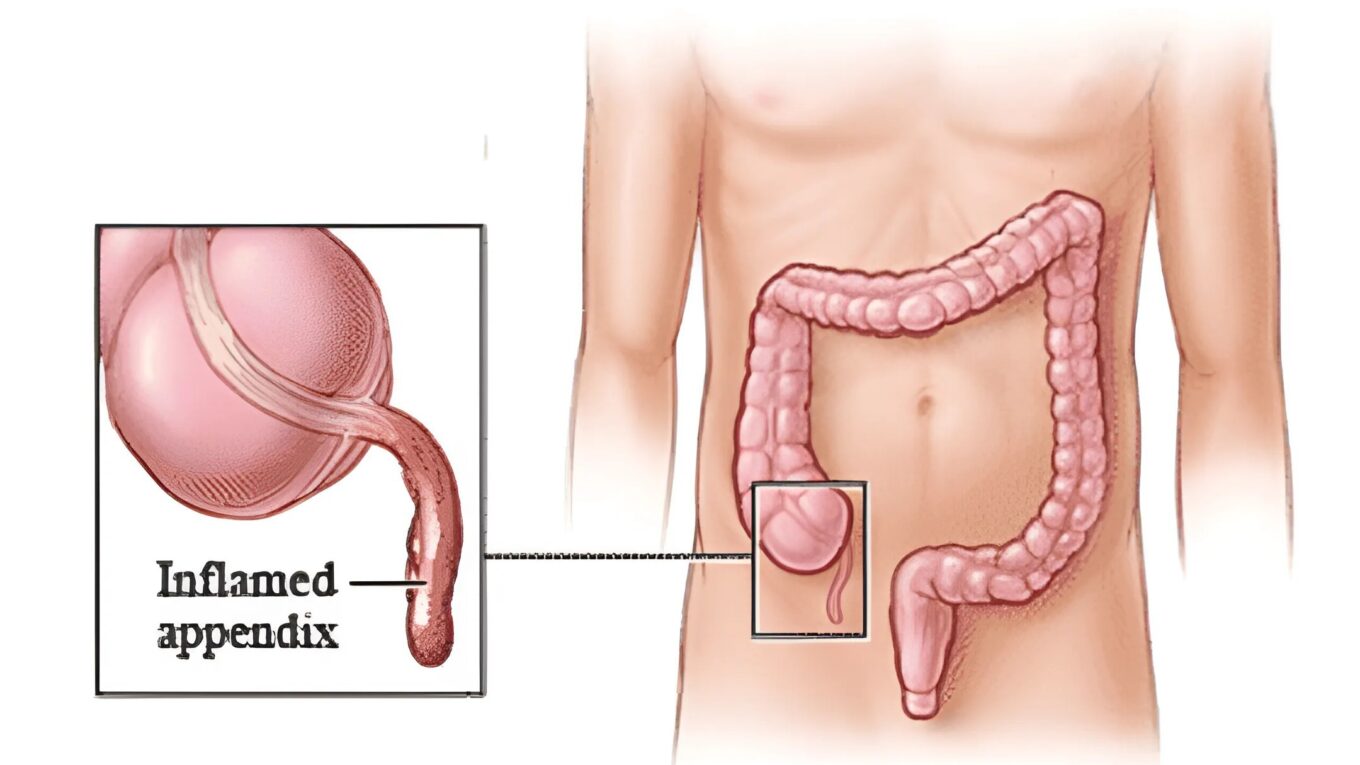 Understanding Appendicitis: Symptoms, Causes, Diagnosis, and Treatment