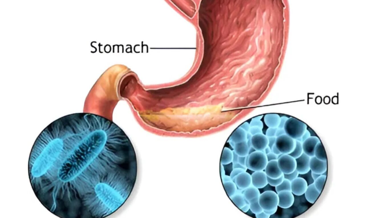 Understanding Food Poisoning: Causes, Symptoms, and Prevention