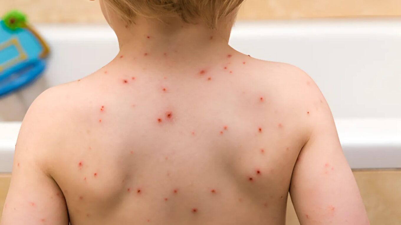 Understanding Chickenpox: Causes, Symptoms, Treatment, and Prevention