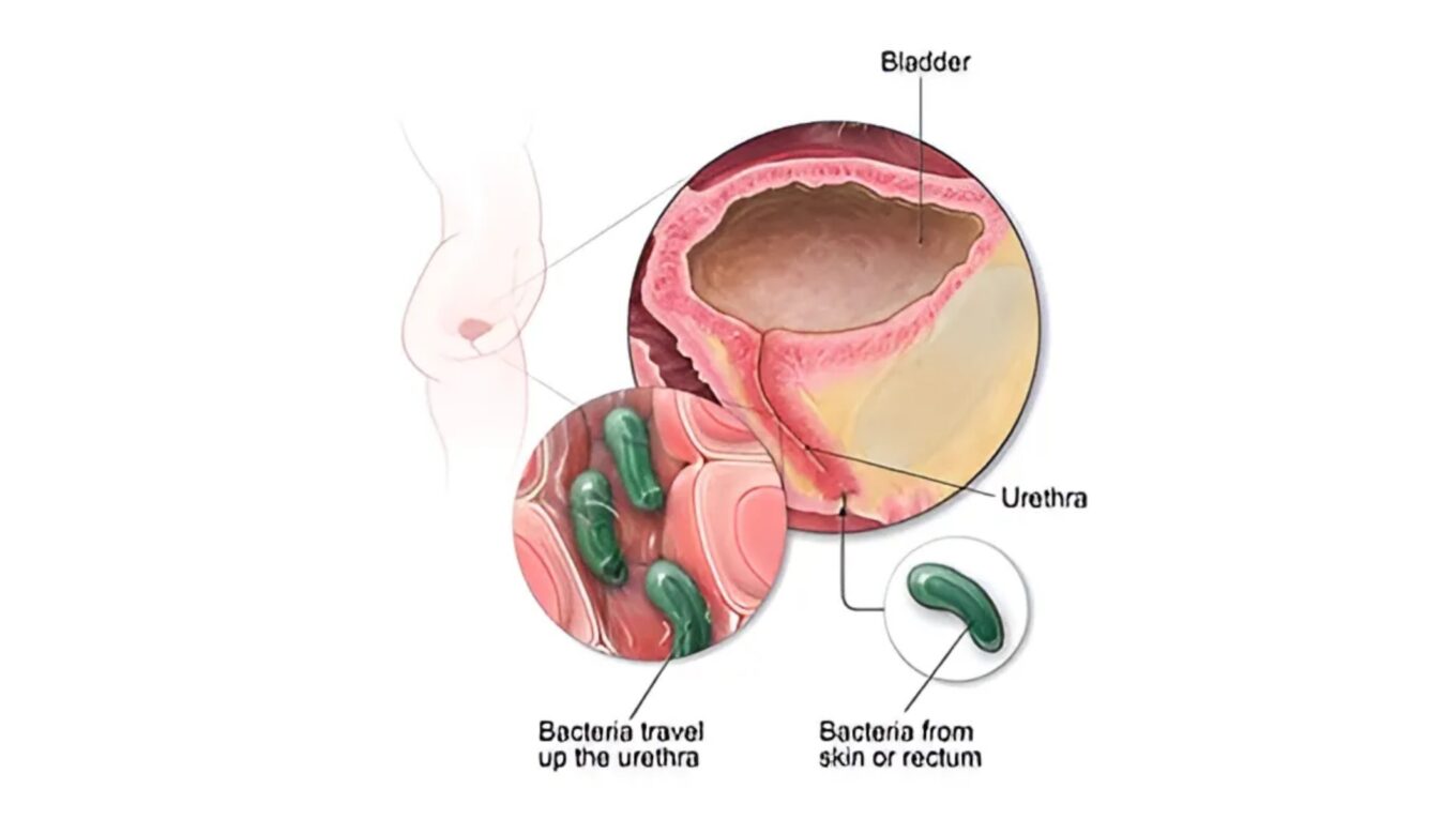 Decoding Urinary Tract Infections (UTIs): Understanding, Addressing, and Preventing