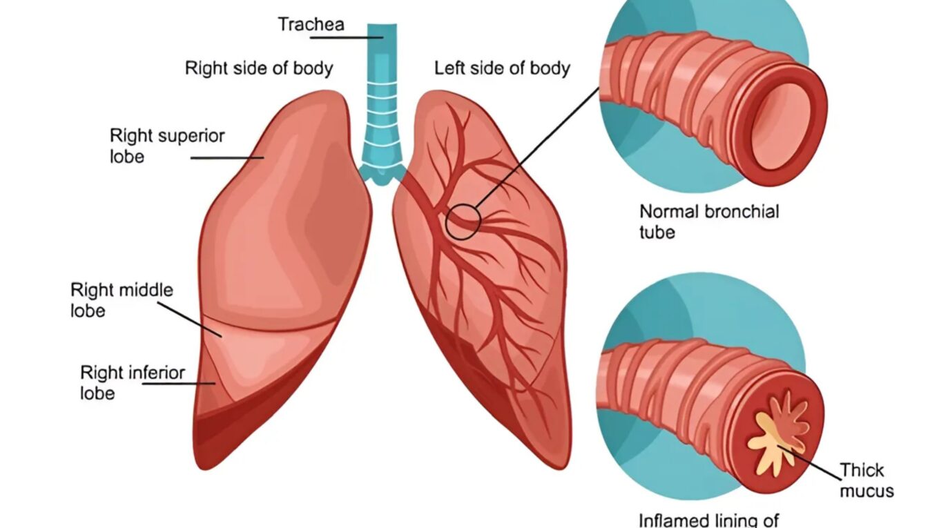 Understanding Bronchitis: Types, Causes, Symptoms, Diagnosis, Treatment and Prevention