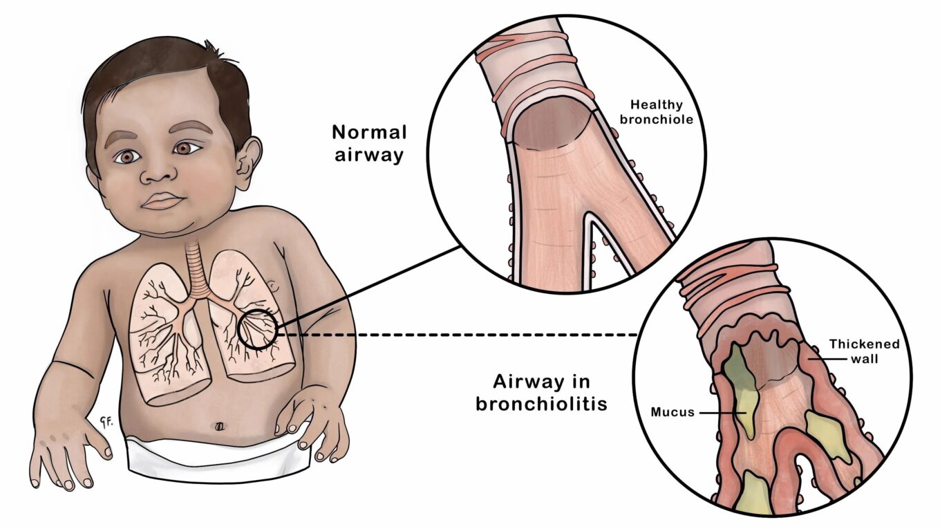 Understanding Bronchiolitis in Children’s: Causes, Symptoms, Diagnosis, and Treatment