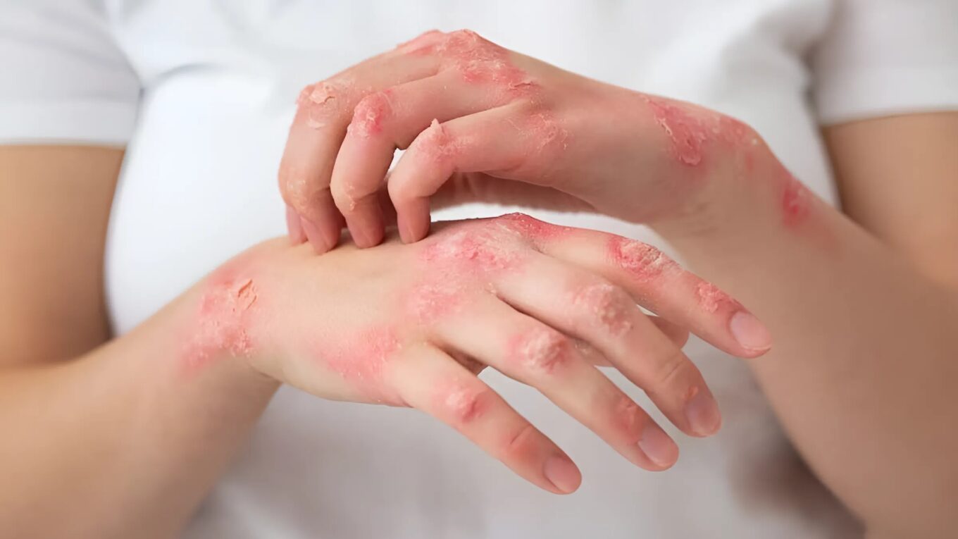 Unveiling Fungal Infections: Causes, Symptoms, Treatment, and Prevention