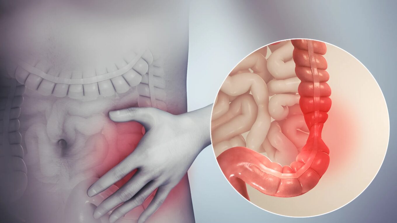 Exploring the Dimensions of Irritable Bowel Syndrome (IBS): Types, Symptoms, Causes, Treatment, and Prevention