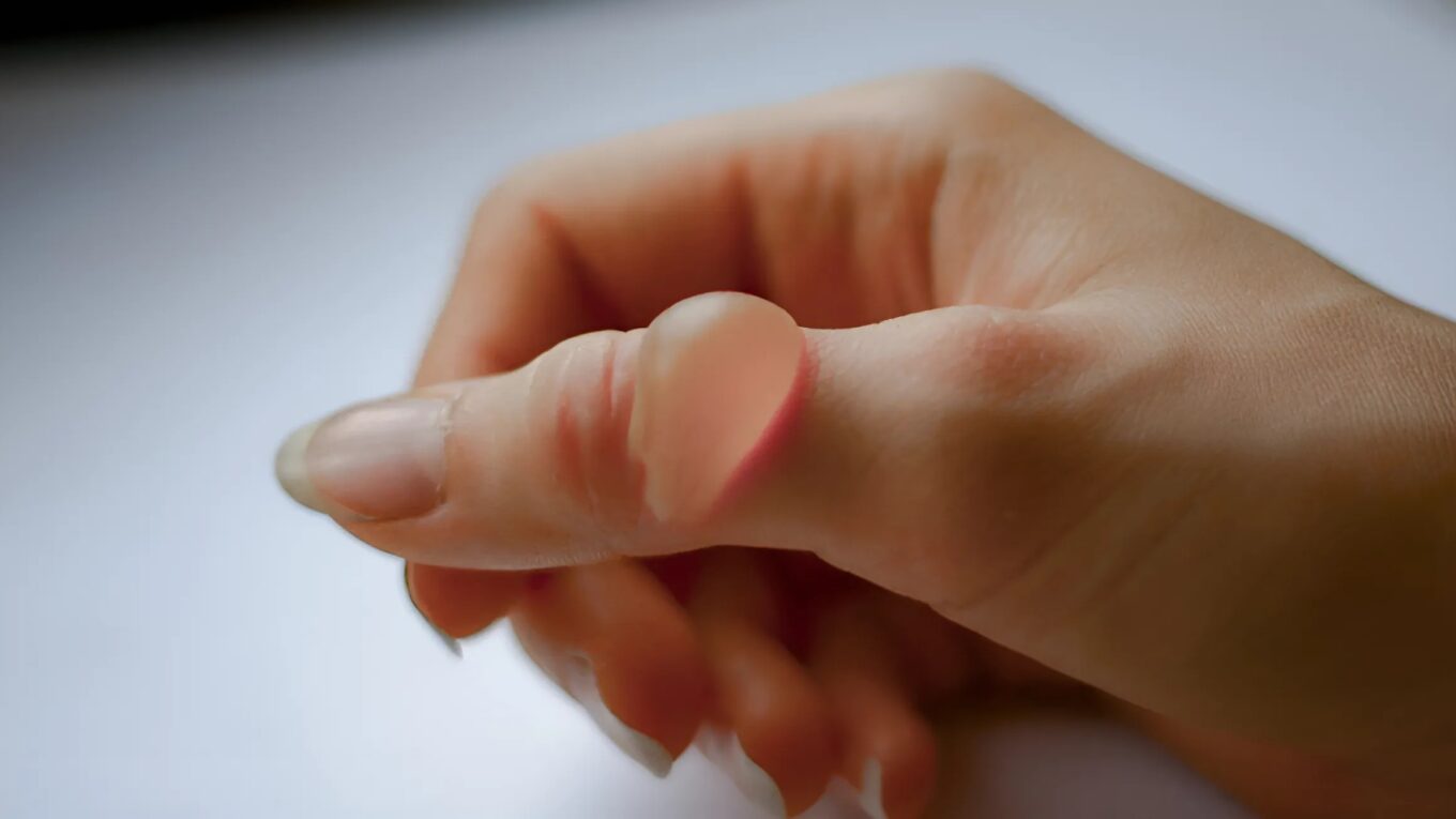 Understanding Blisters: Types, Symptoms, Causes, Diagnosis, and Treatment