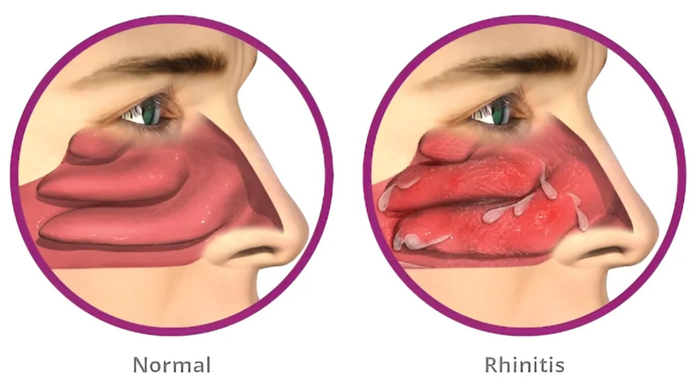 Understanding Allergic Rhinitis: Symptoms, Causes, and Management