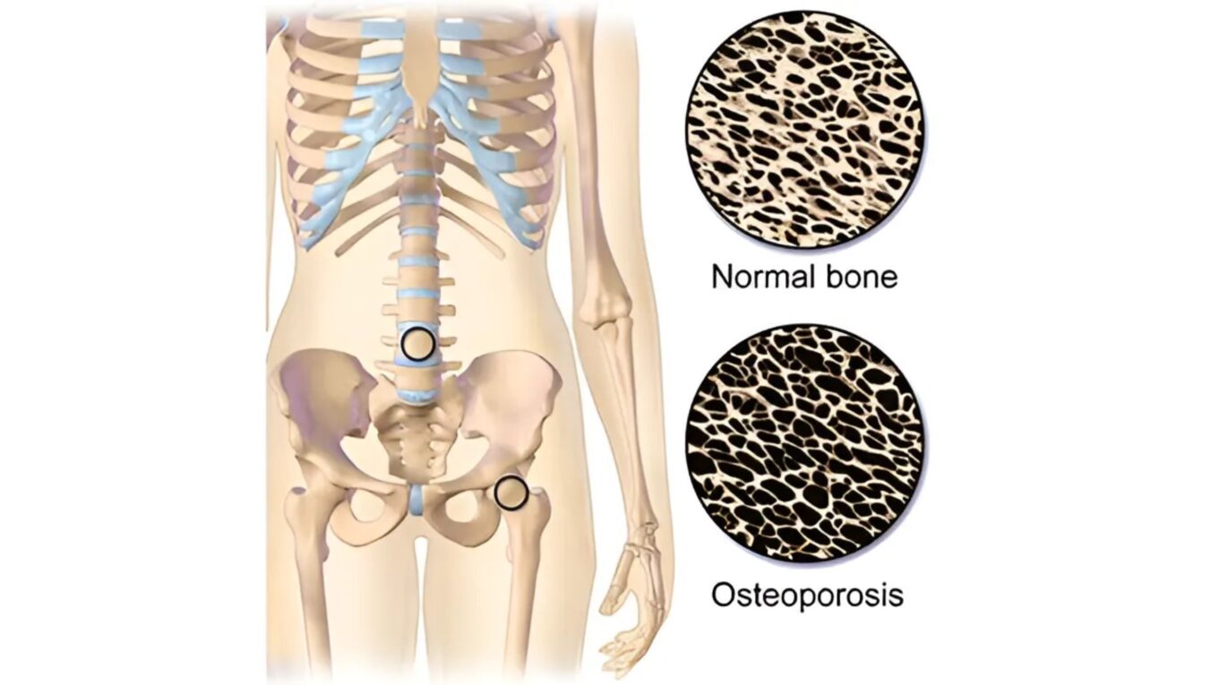 Osteoporosis: Understanding the Silent Disease