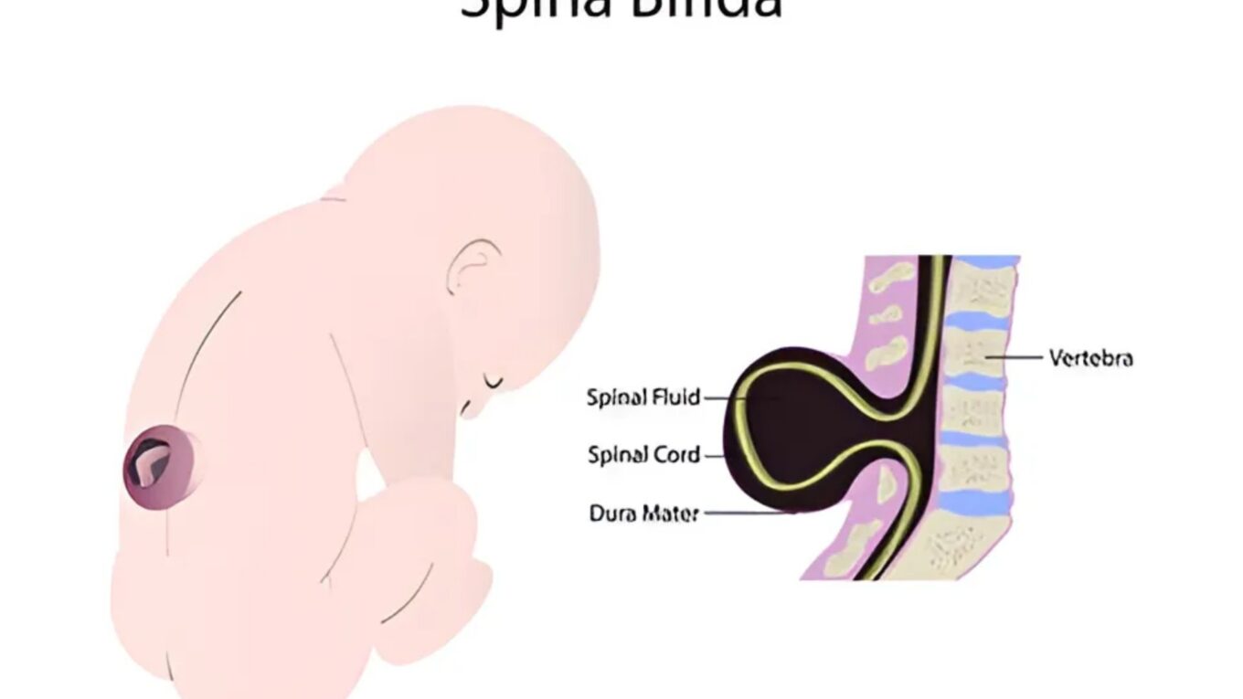 Understanding Spina Bifida: Types, Causes, Symptoms, Prevention, and Treatment