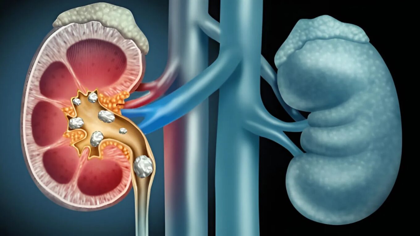 Understanding Chronic Kidney Disease (CKD): A Comprehensive Guide