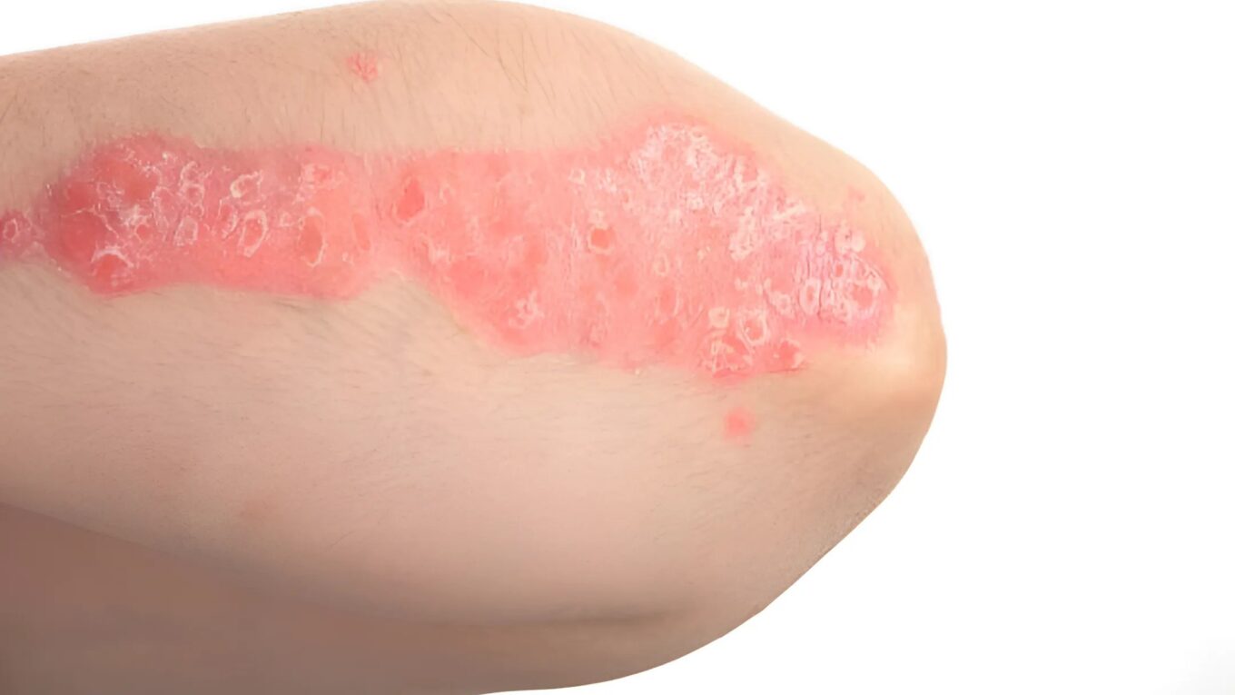 Understanding Scabies: Causes, Symptoms, Treatment, and Prevention