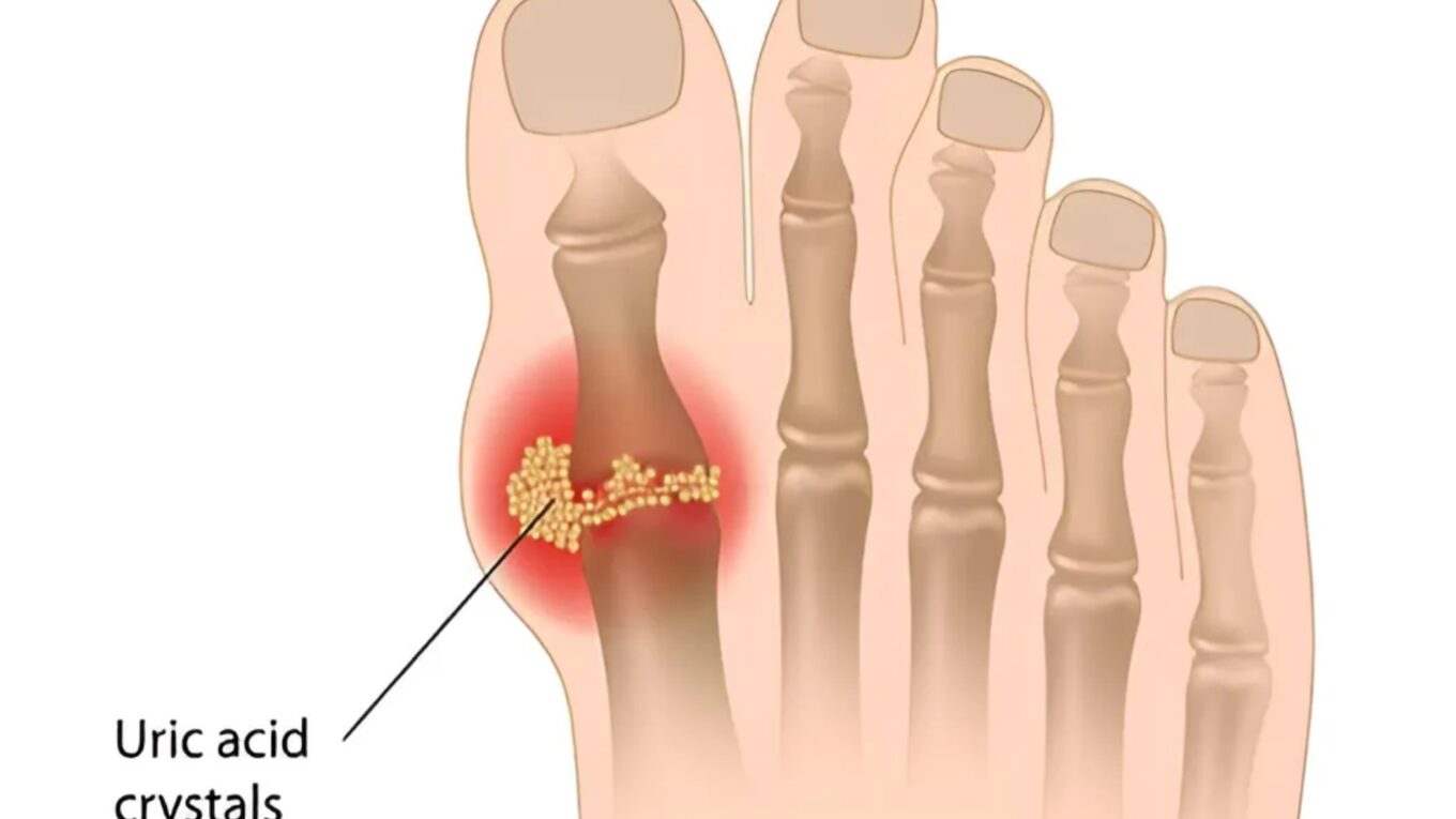 Understanding Uric Acid: Causes, Symptoms, Prevention, and Treatment