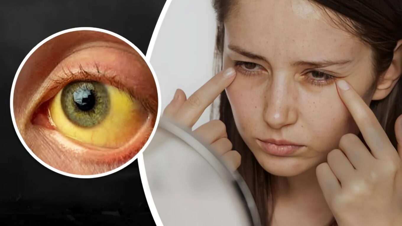 Understanding Jaundice: Causes, Symptoms, Diagnosis, and Treatment