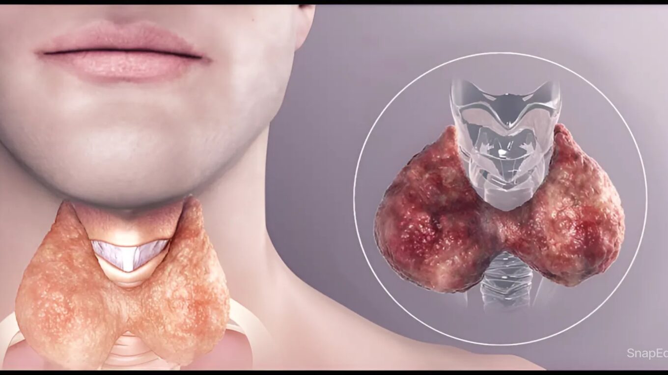 Delving Deeper into Thyroid Syndrome: Unraveling Symptoms, Types, and Treatments