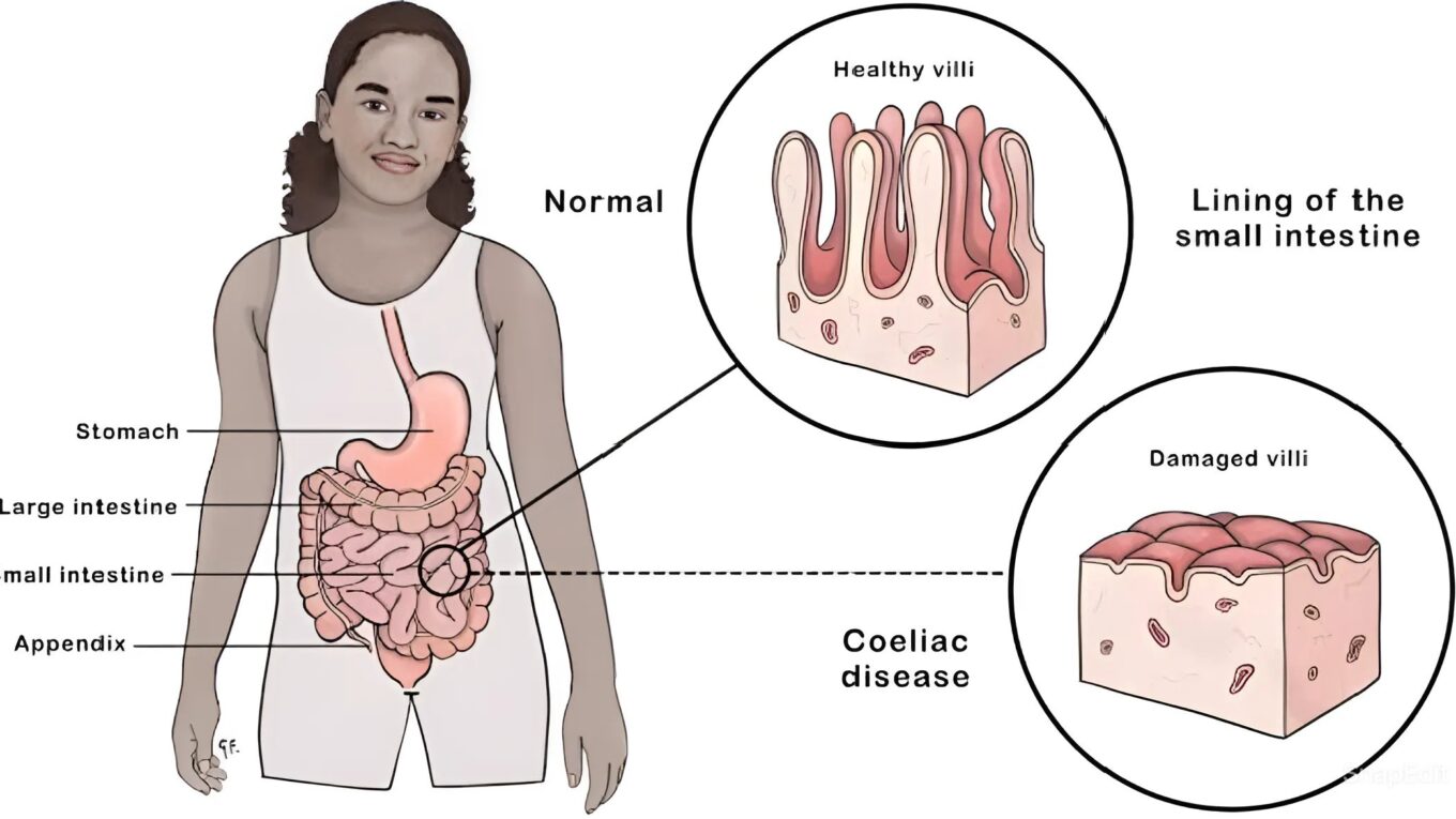 Unraveling Celiac Disease: A Deep Dive into Symptoms, Diagnosis, Treatment, and Coping Strategies