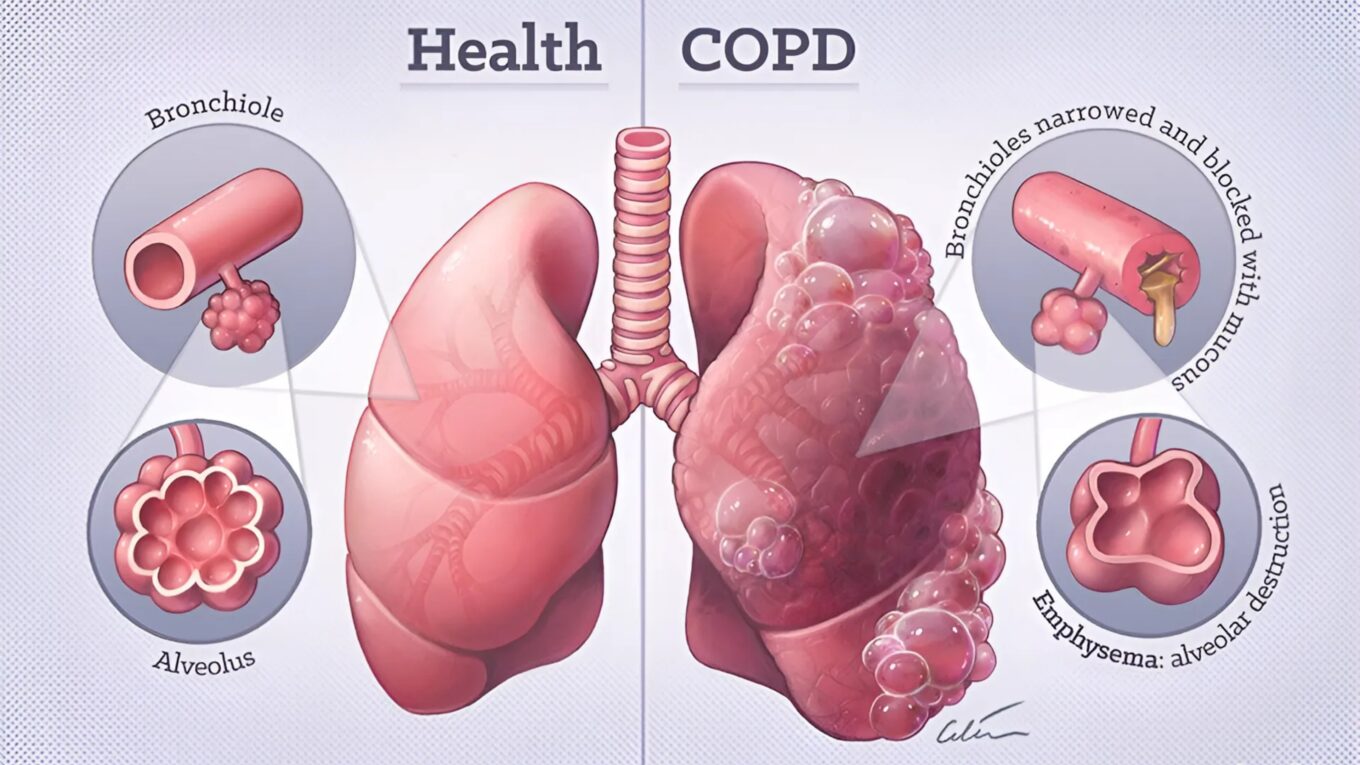 Understanding COPD: Causes, Symptoms, and Management