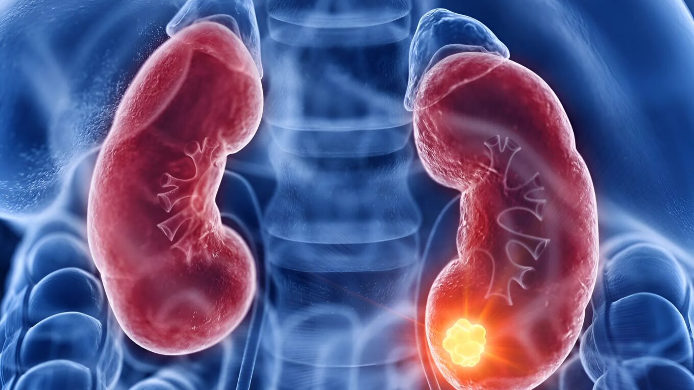 Unveiling Acute Renal Failure: Unraveling the Mysteries of Kidney Health