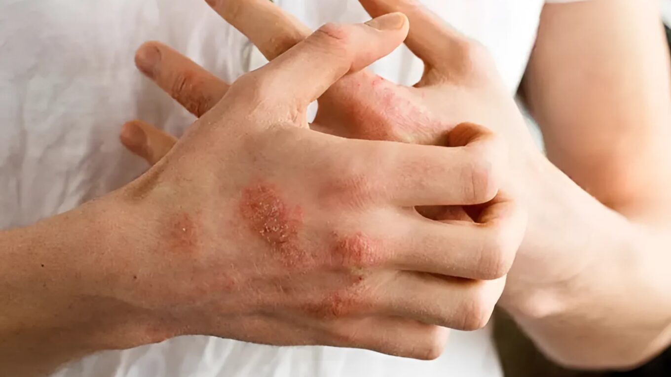 Exploring Eczema: Causes, Symptoms, Diagnosis, Prevention, and Treatment