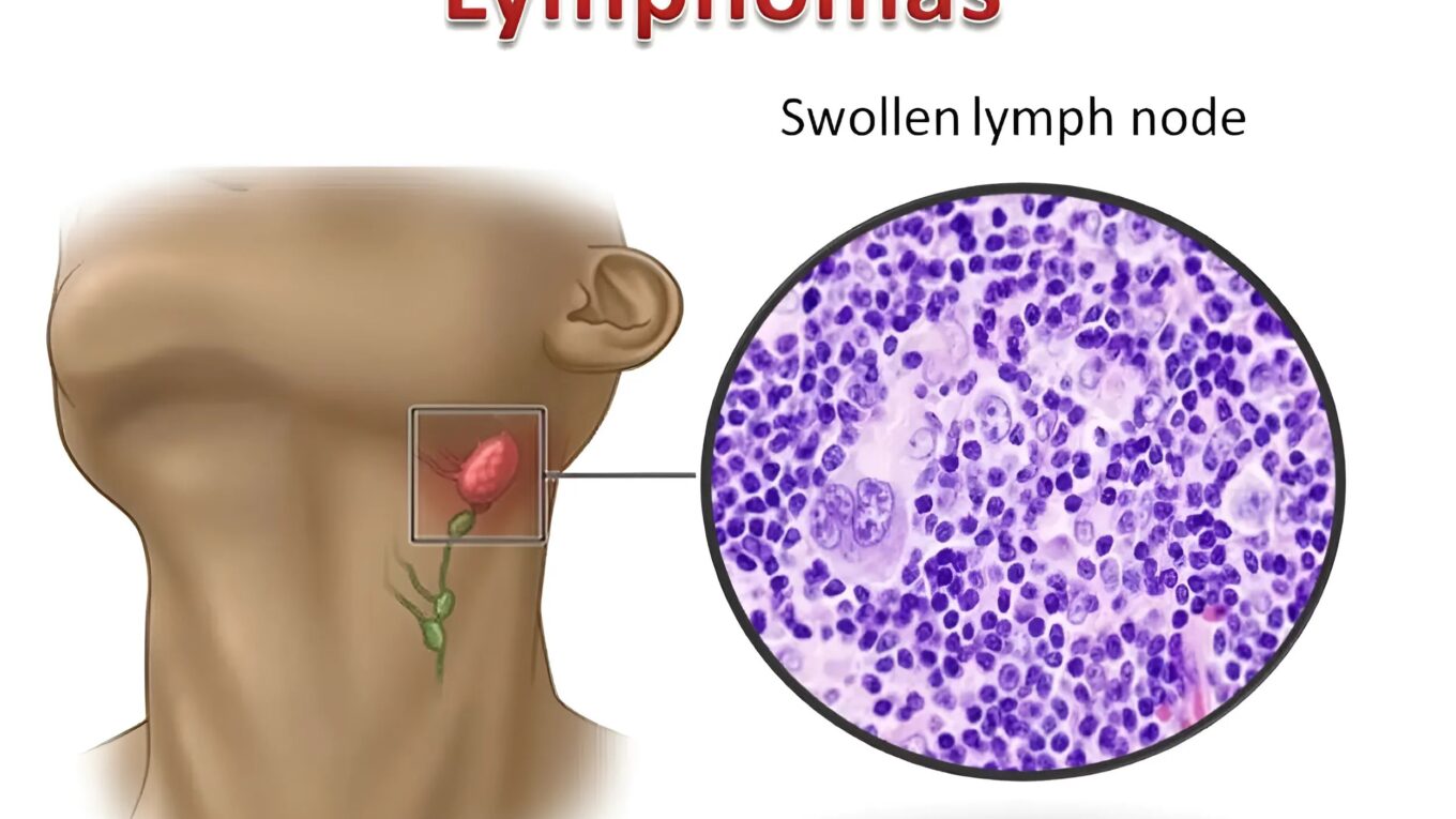 Understanding Lymphomas: Types, Symptoms, Diagnosis, and Treatment