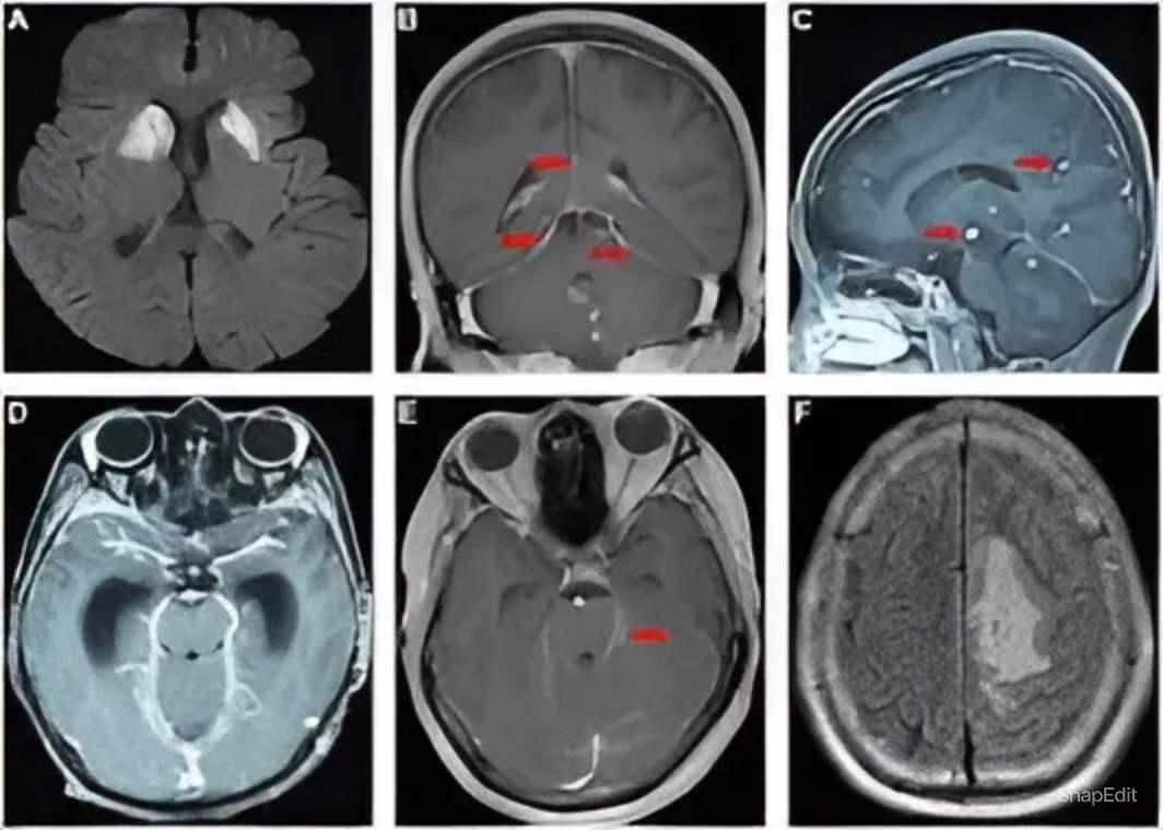 Understanding Tuberculosis Meningitis: A Comprehensive Overview