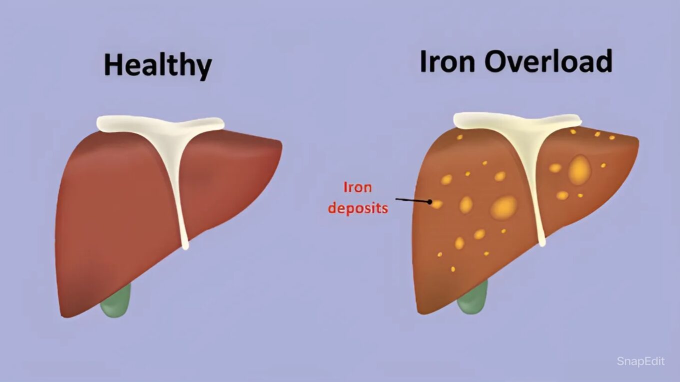 Understanding Hemochromatosis: A Comprehensive Guide