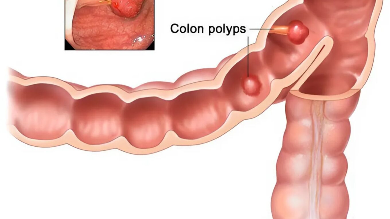 Complete Guide to Colon Polyps